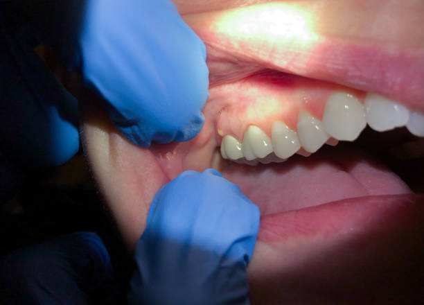Best Dental Abscess Treatment in Warm Springs, CA